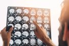 Un de cada quatre persones tindrà un ictus